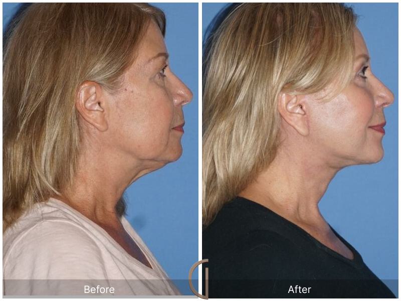 Facelift Sixties Before & After Photo