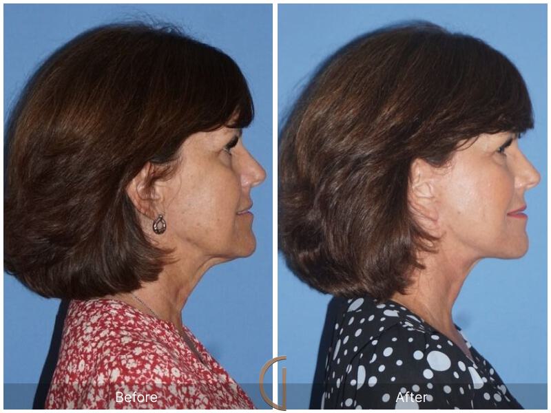 Facelift Sixties Before & After Photo