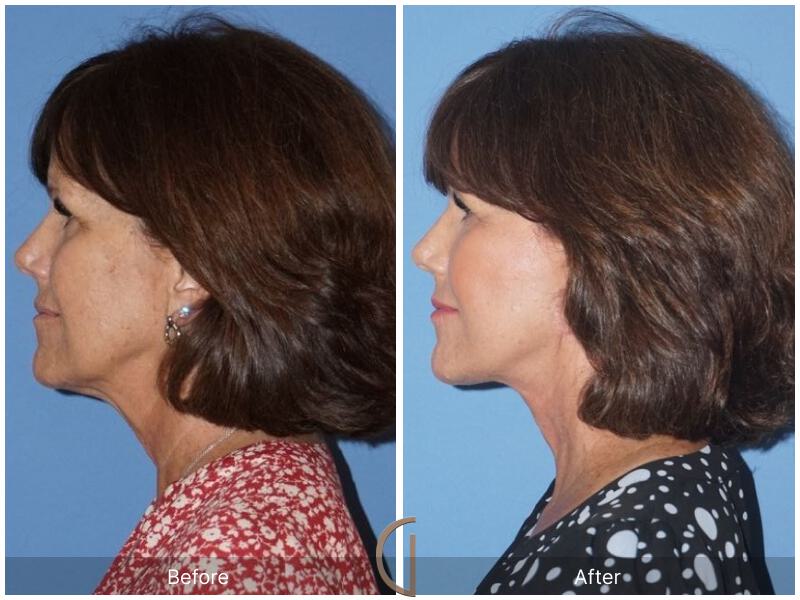 Facelift Sixties Before & After Photo