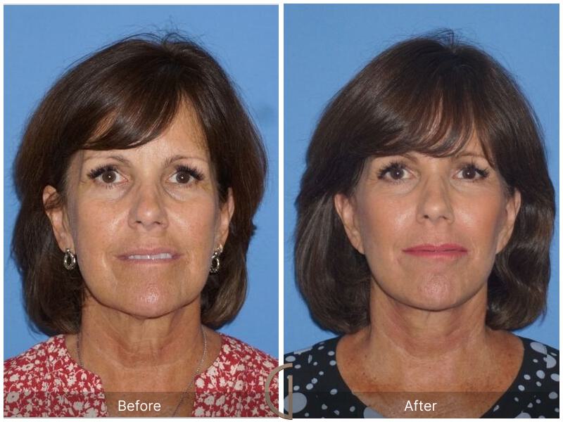 Facelift Sixties Before & After Photo