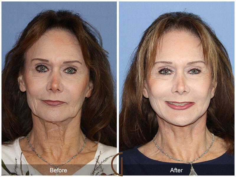 Facelift Sixties Before & After Photo