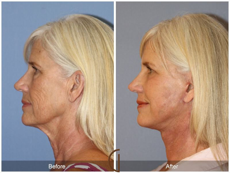 Facelift Sixties Before & After Photo