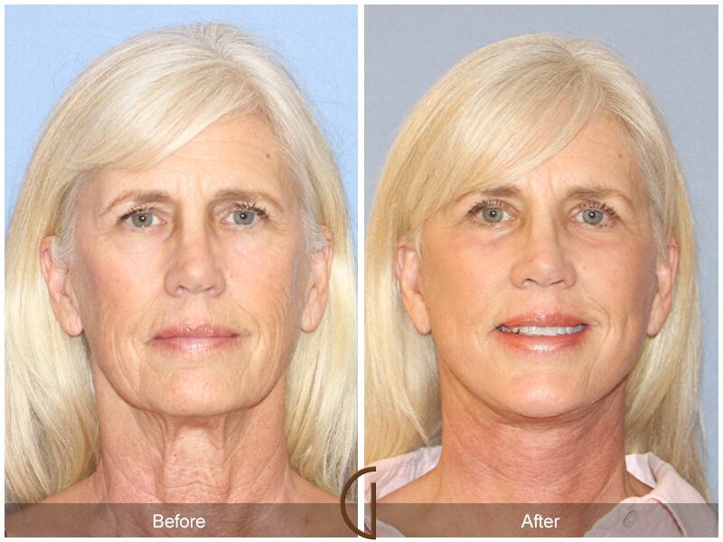 Facelift Sixties Before & After Photo