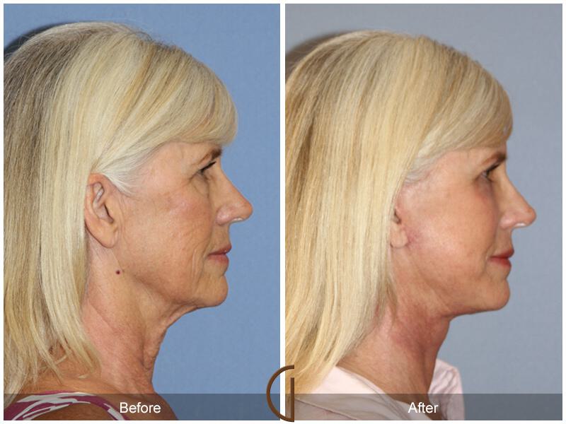 Facelift Sixties Before & After Photo