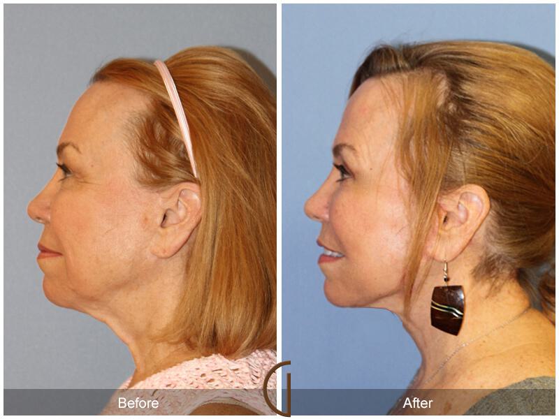 Facelift Sixties Before & After Photo