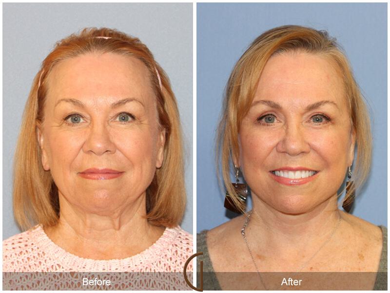 Facelift Sixties Before & After Photo