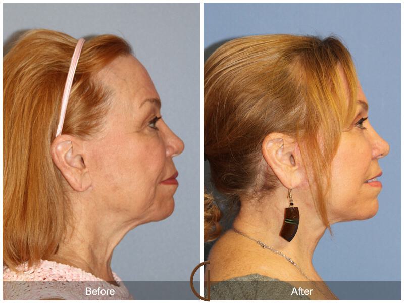 Facelift Sixties Before & After Photo