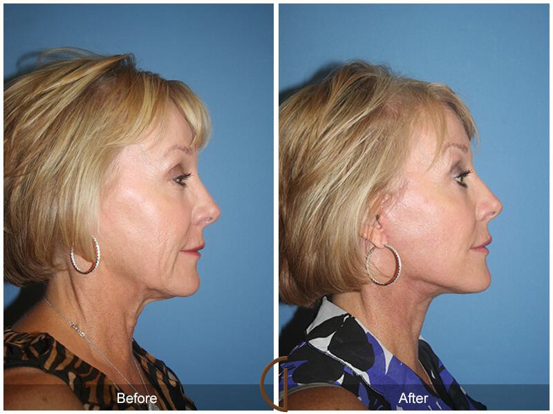 Facelift Sixties Before & After Photo