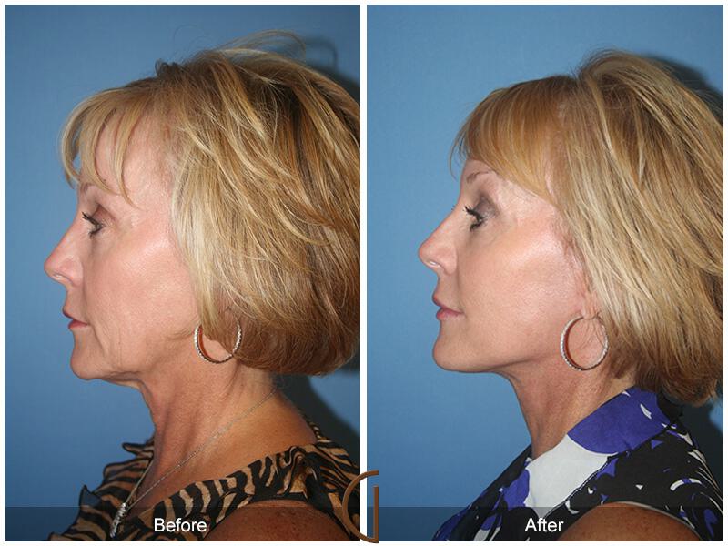 Facelift Sixties Before & After Photo