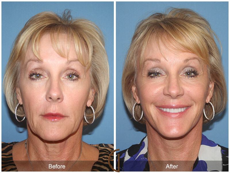 Facelift Sixties Before & After Photo