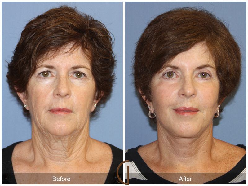 Facelift Sixties Before & After Photo