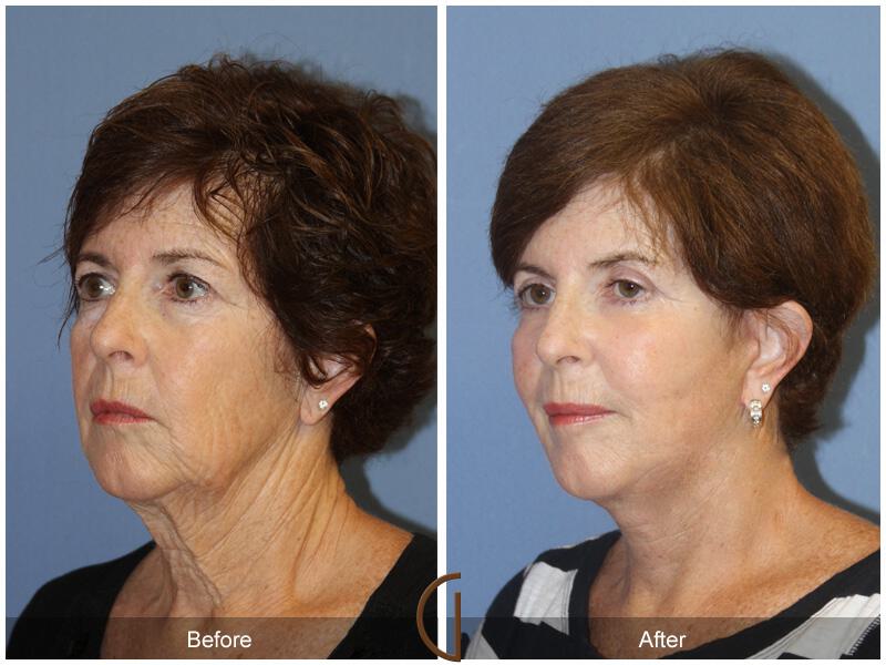 Facelift Sixties Before & After Photo