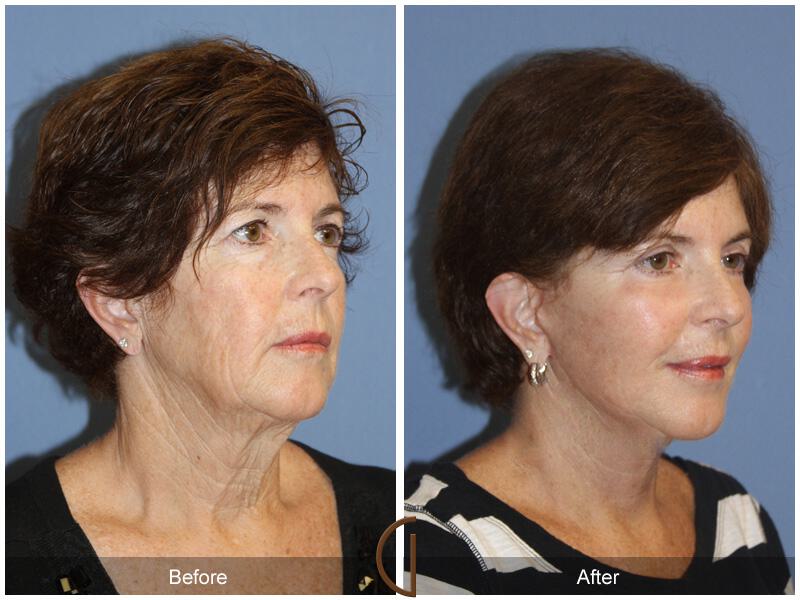 Facelift Sixties Before & After Photo