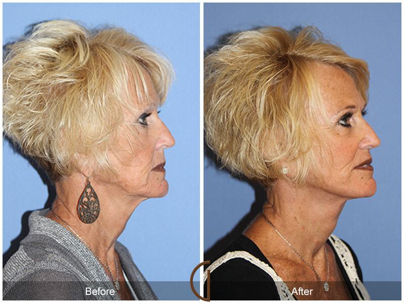 Facelift Sixties Before & After Photo