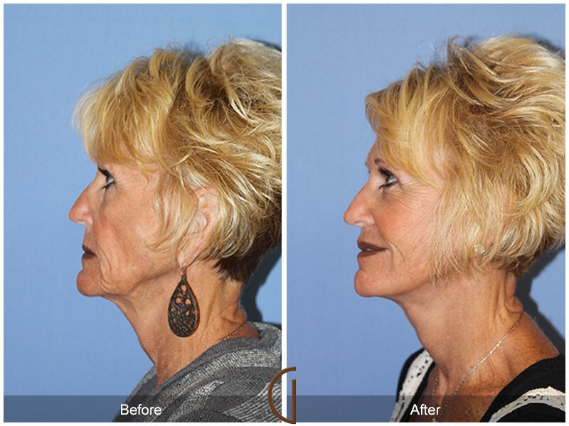 Facelift Sixties Before & After Photo