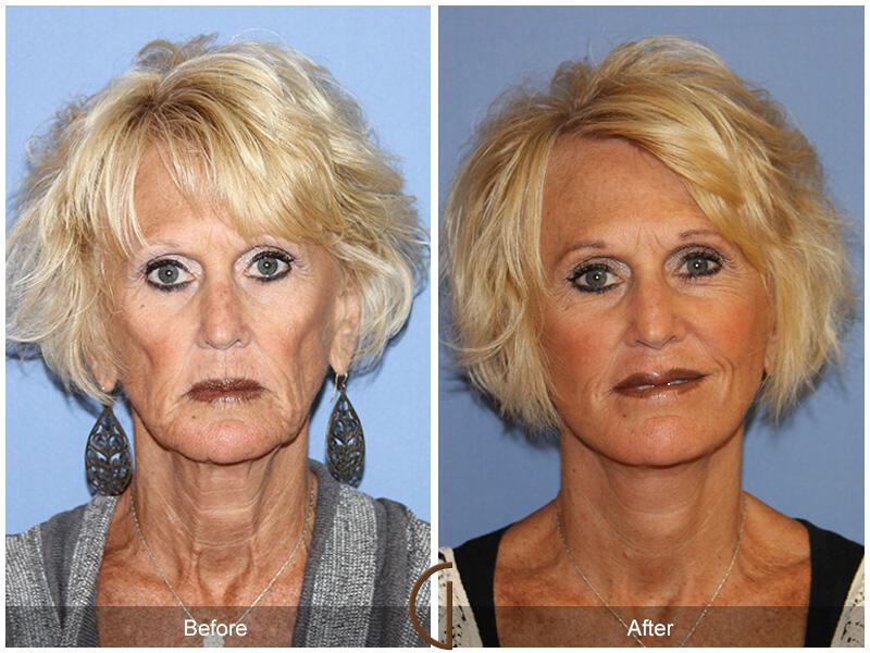 Facelift Sixties Before & After Photo