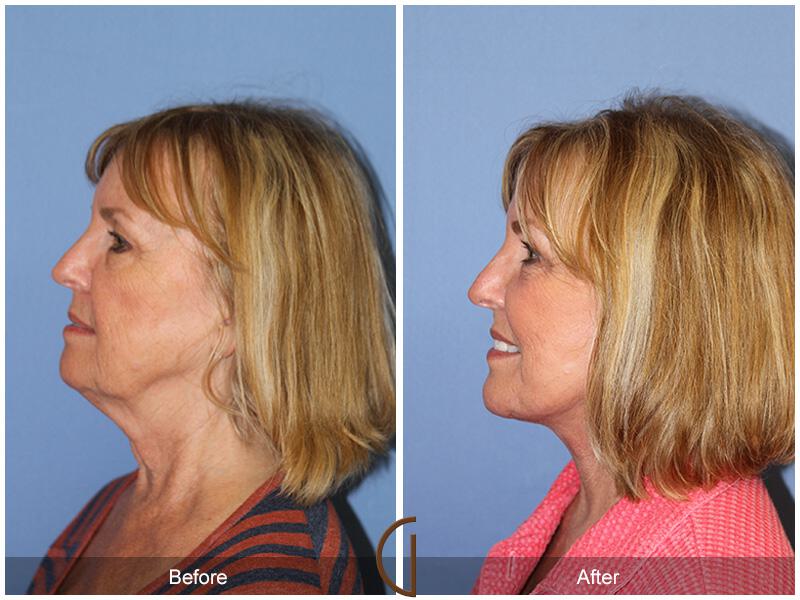 Facelift Sixties Before & After Photo