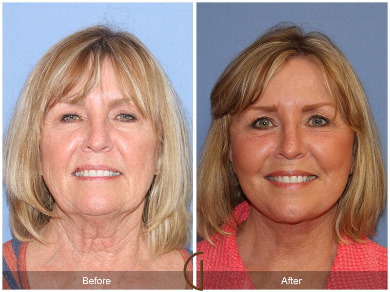 Facelift Sixties Before & After Photo