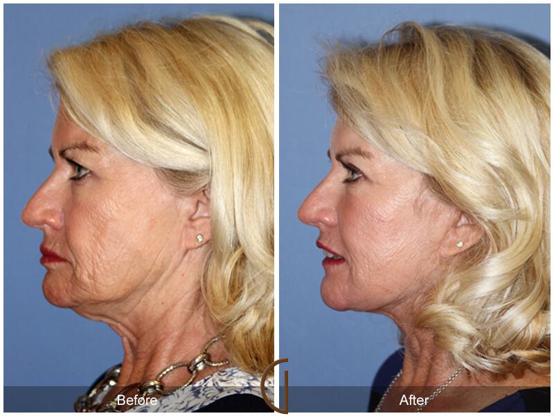 Facelift Sixties Before & After Photo