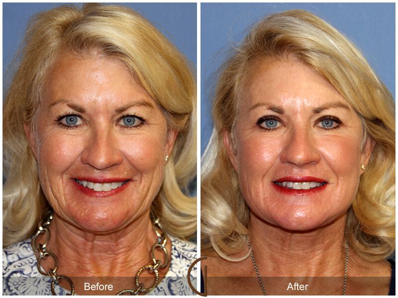 Facelift Sixties Before & After Photo