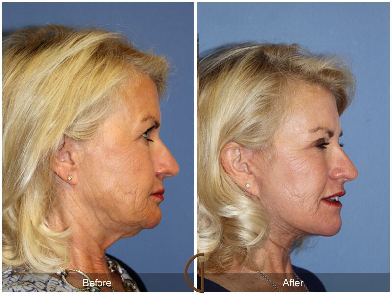 Facelift Sixties Before & After Photo