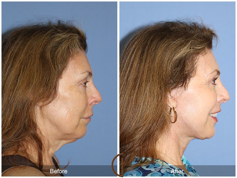 Facelift Sixties Before & After Photo