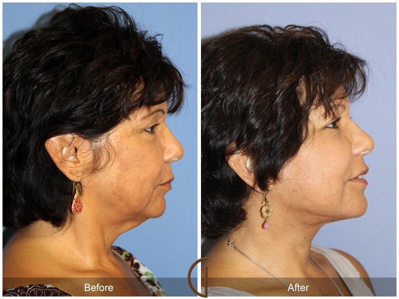 Facelift Sixties Before & After Photo