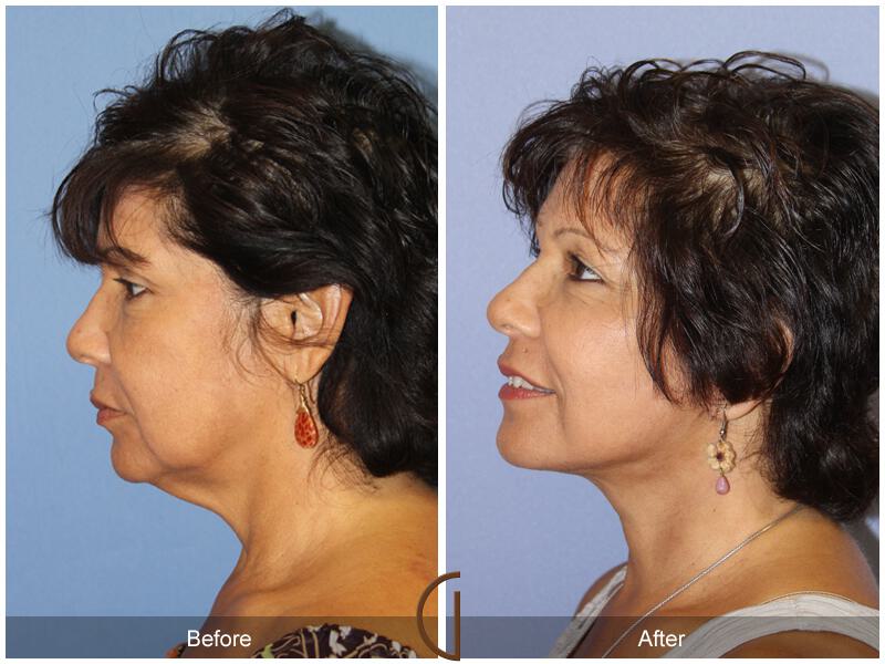 Facelift Sixties Before & After Photo