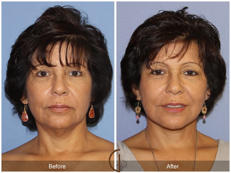 Facelift Sixties Before & After Photo