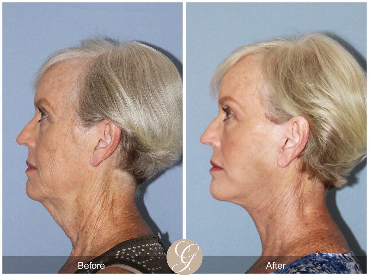 Facelift Sixties Before & After Photo