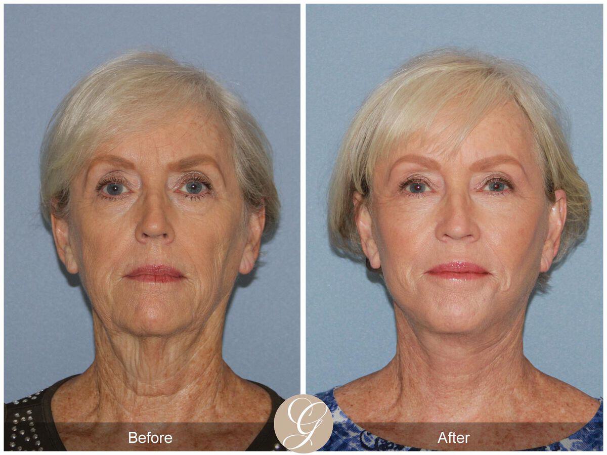 Facelift Sixties Before & After Photo