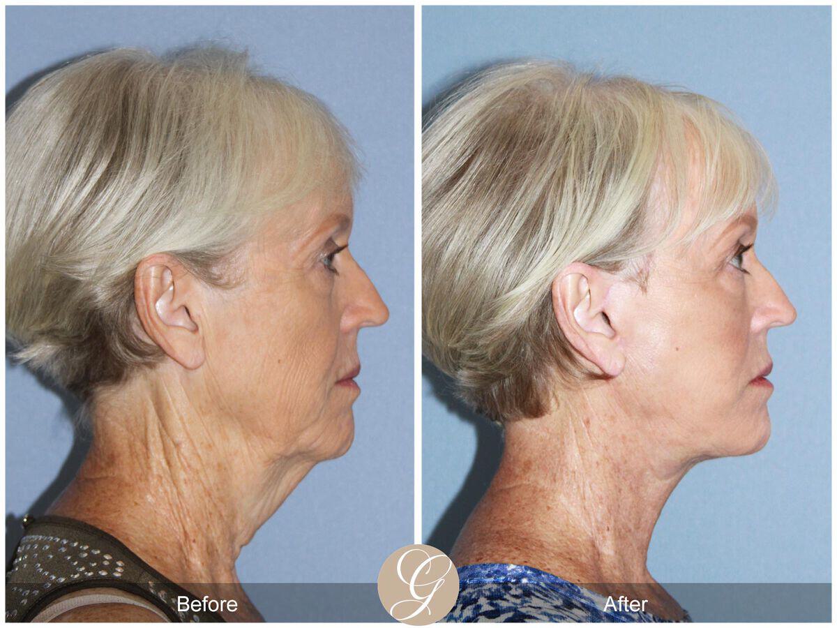 Facelift Sixties Before & After Photo