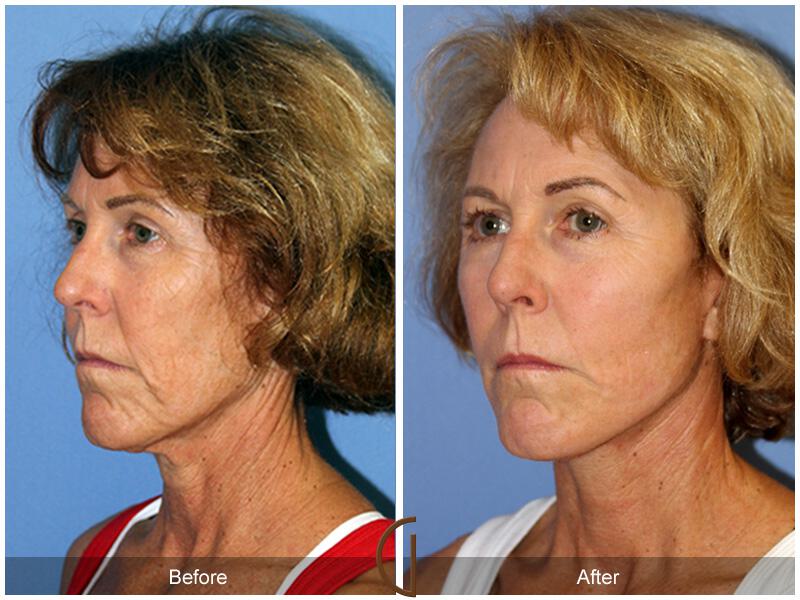 Facelift Sixties Before & After Photo