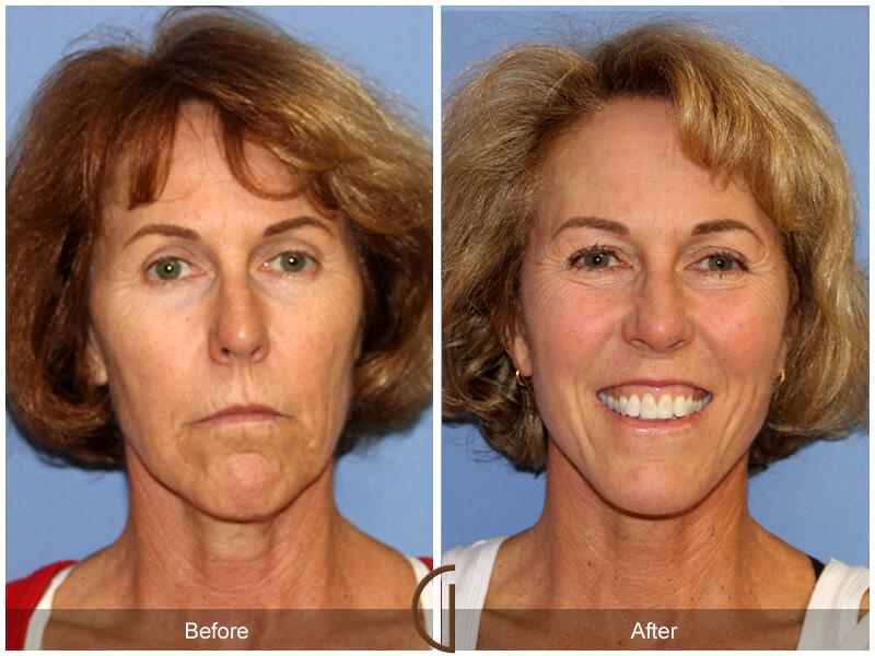 Facelift Sixties Before & After Photo