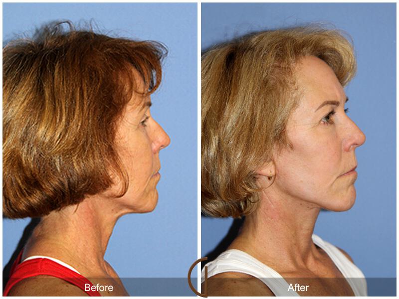 Facelift Sixties Before & After Photo