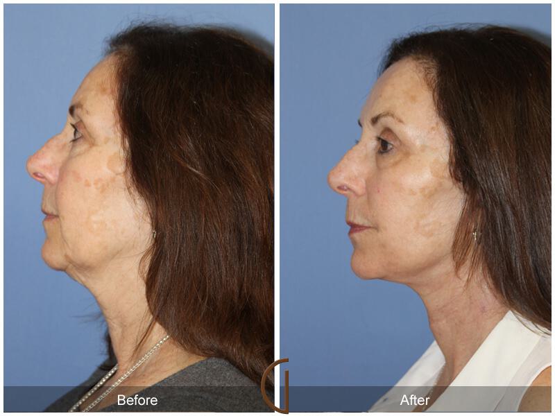 Facelift Sixties Before & After Photo