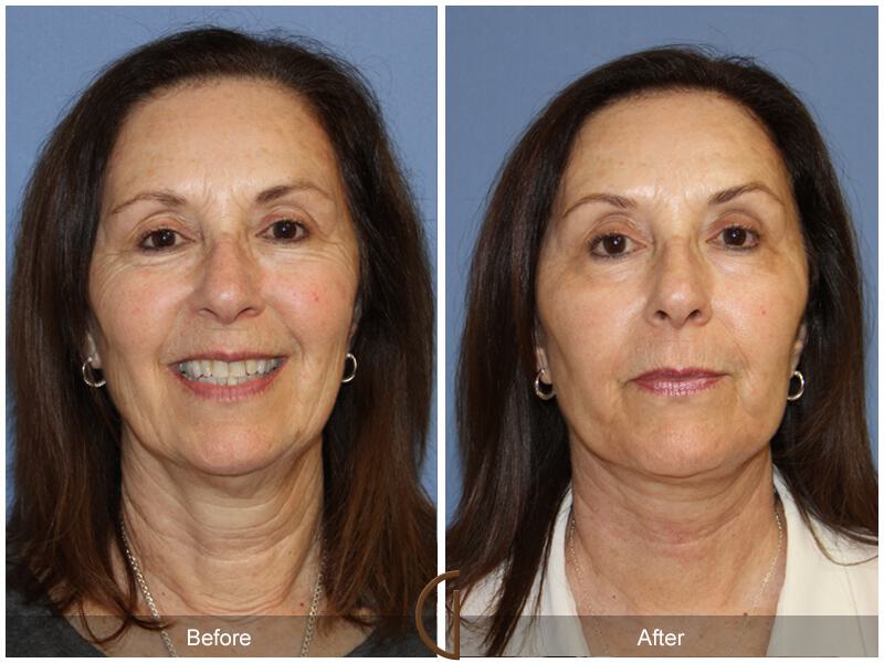 Facelift Sixties Before & After Photo