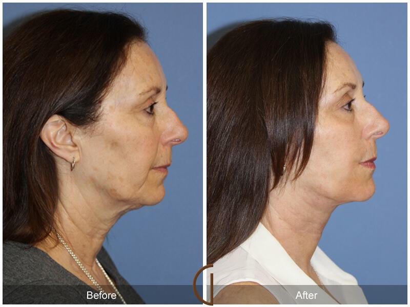 Facelift Sixties Before & After Photo