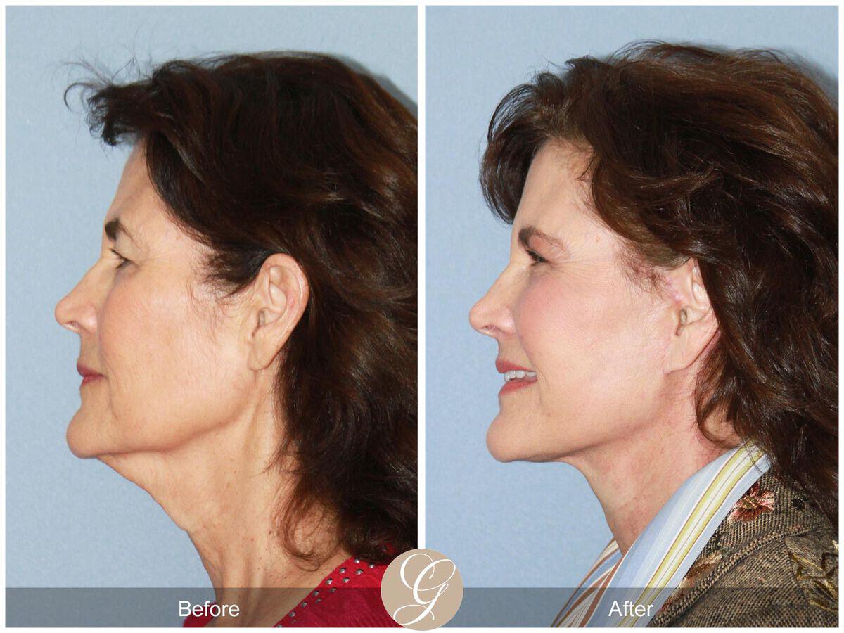 Facelift Sixties Before & After Photo