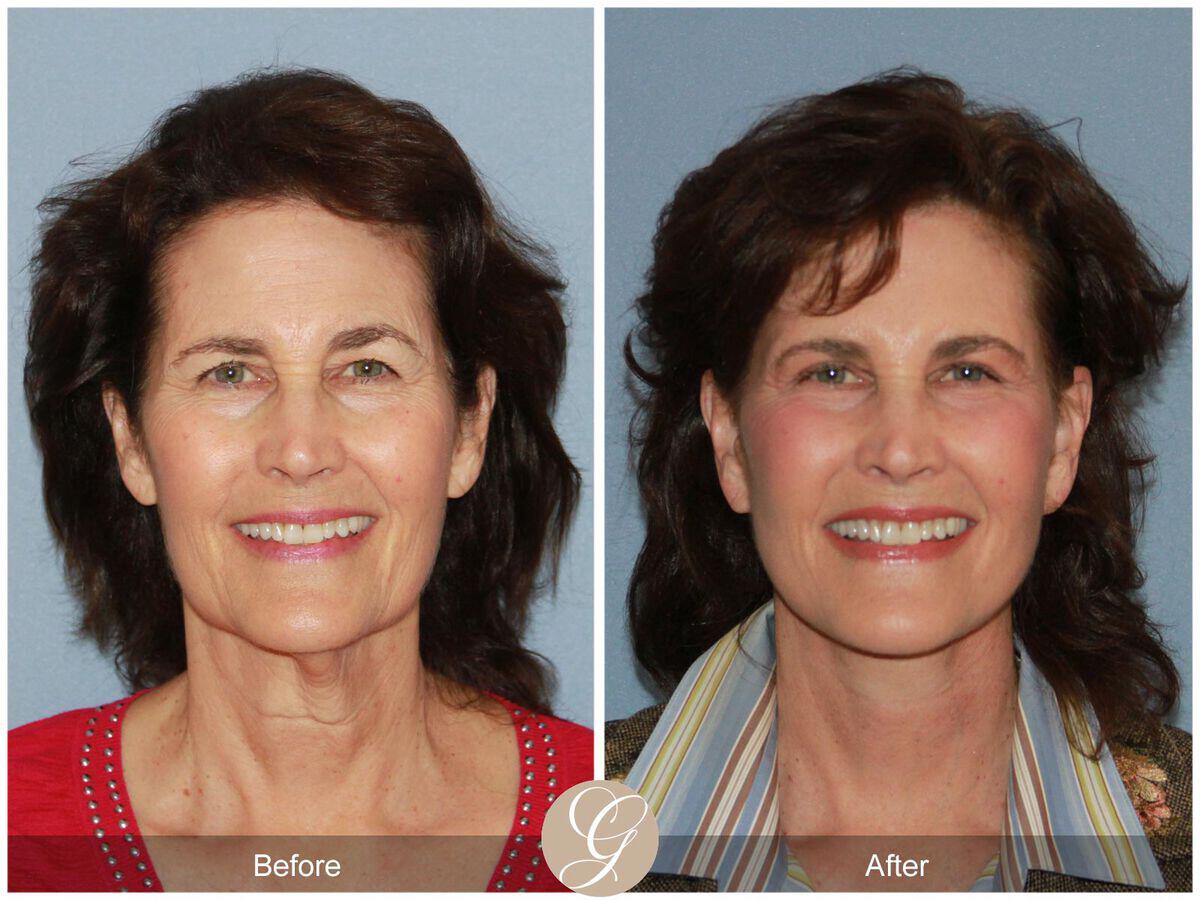 Facelift Sixties Before & After Photo