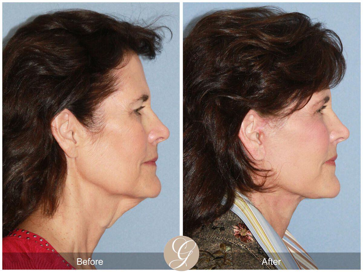 Facelift Sixties Before & After Photo