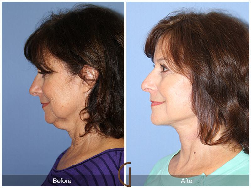 Facelift Sixties Before & After Photo