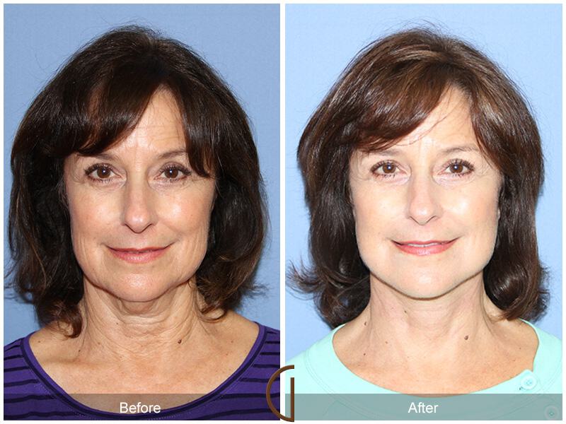 Facelift Sixties Before & After Photo