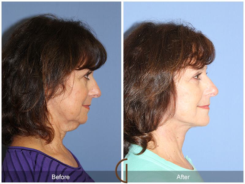 Facelift Sixties Before & After Photo