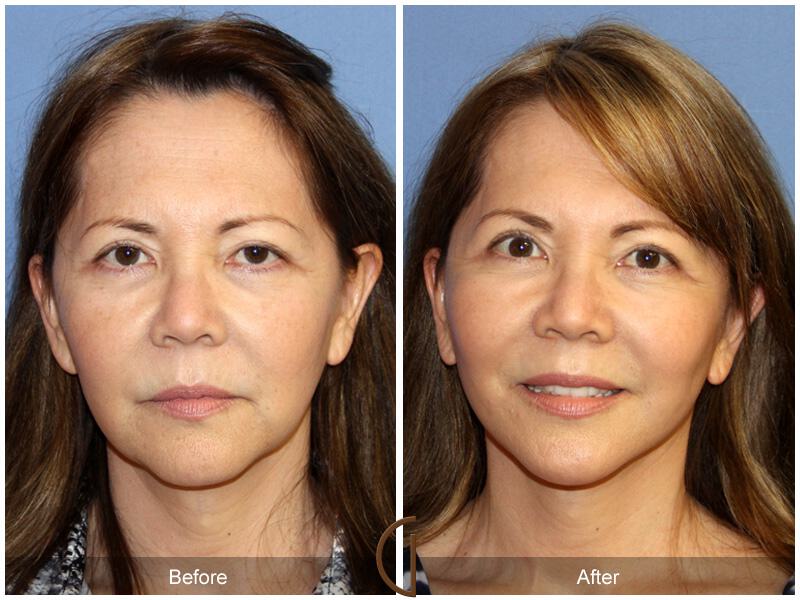 Facelift Sixties Before & After Photo