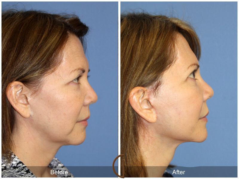 Facelift Sixties Before & After Photo