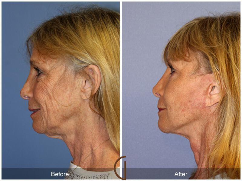 Facelift Sixties Before & After Photo