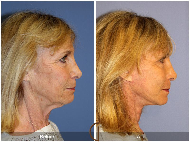 Facelift Sixties Before & After Photo