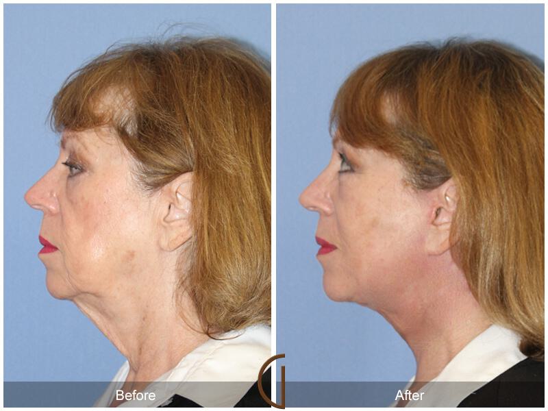 Facelift Sixties Before & After Photo