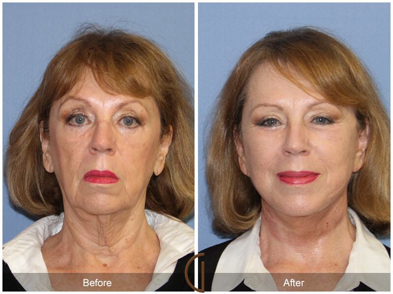 Facelift Sixties Before & After Photo